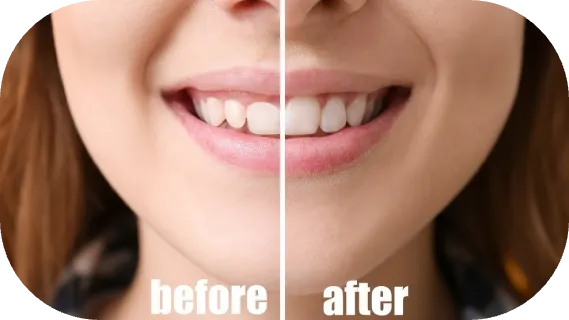 gummy smile