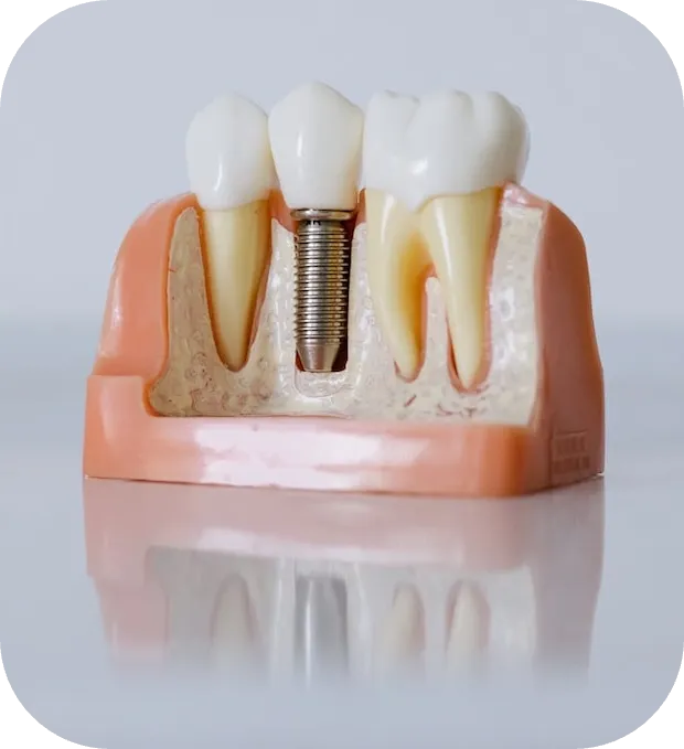 zubní implantát