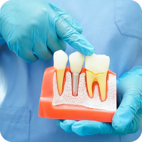 implantaty 